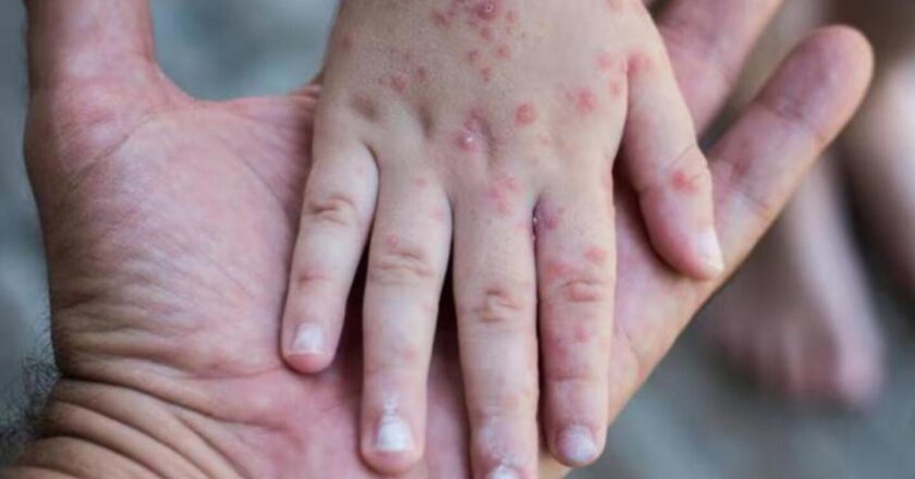 La Paz activa vigilancia epidemiológica por casos de sarampión en Santa Cruz